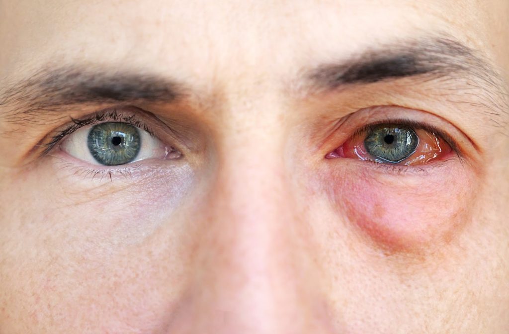 Allergies or Pink Eye: Here's How to Tell the Difference