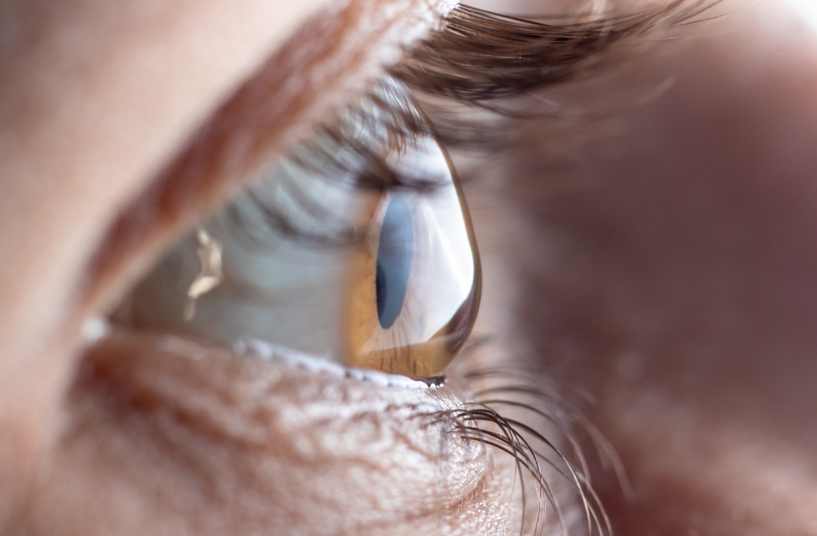 Eye with astigmatism 1