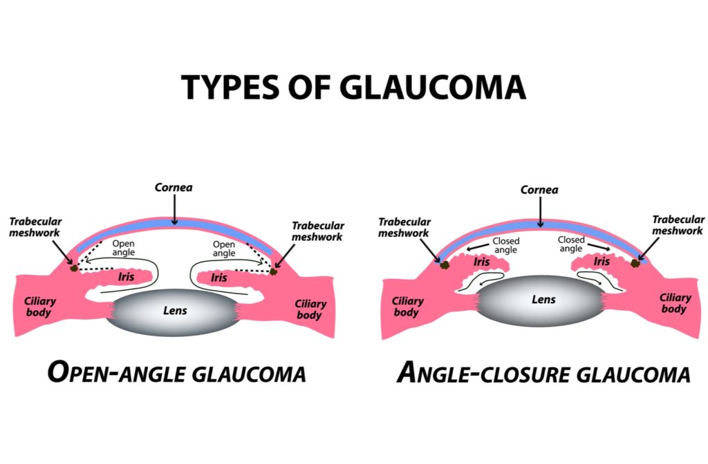 A detailed comparison of open-angle glaucoma and angle-closure glaucoma and how exactly it impacts the eye