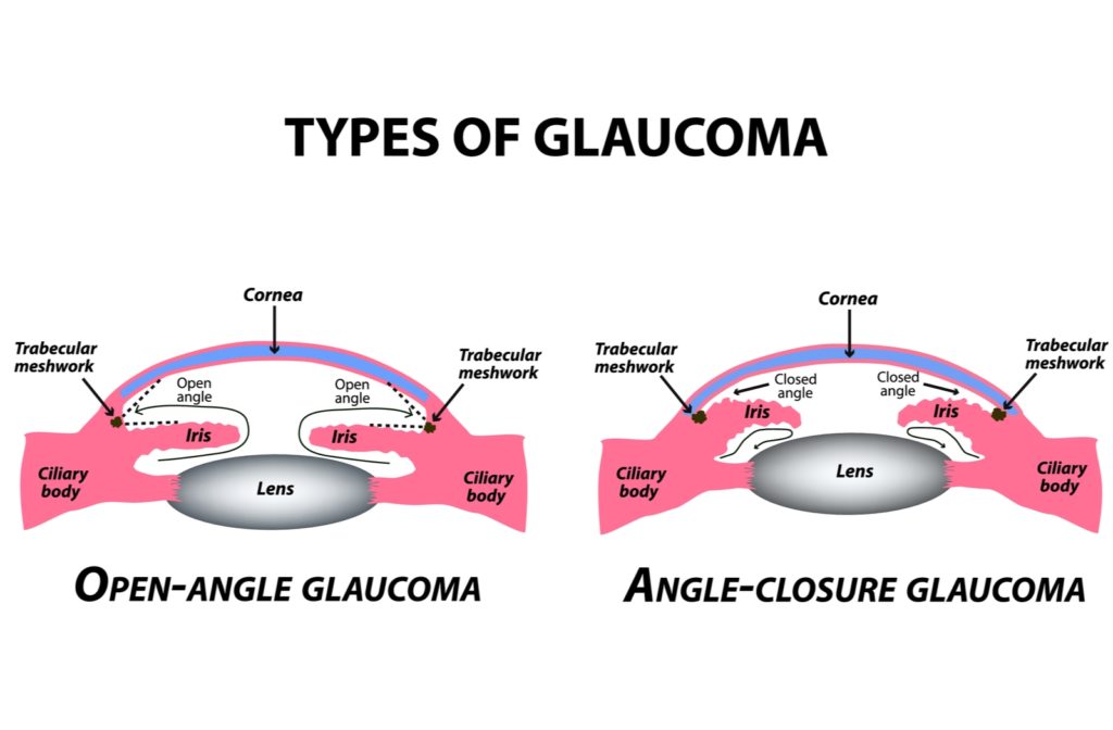 Is Glaucoma Hereditary Brooklyn Park Slope Eye