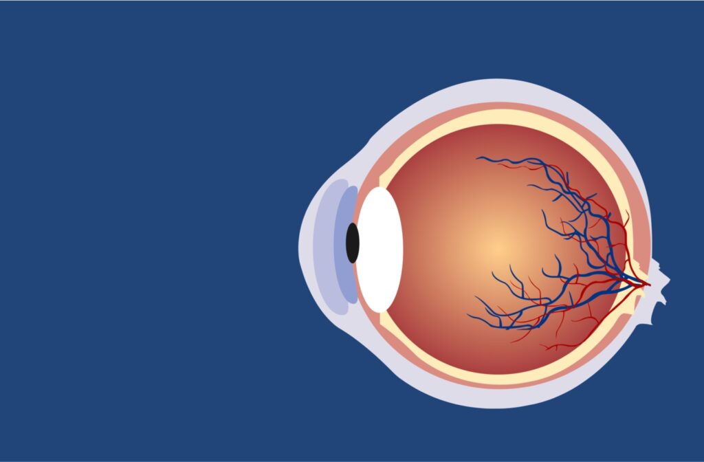 An illustration of an eyeball with Diabetic Retinopathy on a navy blue background