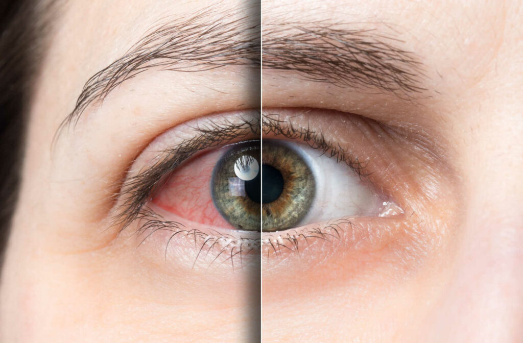 An image split in half to depict the before and after of dry eye treatment with a red eye on the left and a healthy eye on the right.