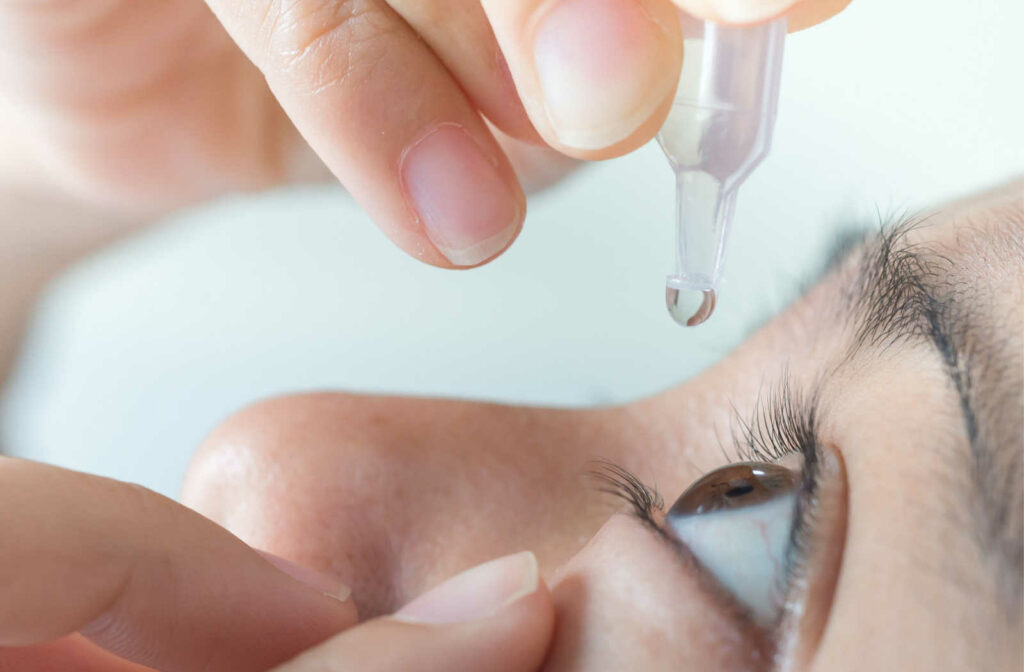 A close up of a person administering eye drops in their eye to help alleviate the symptoms of dry eye disease.
