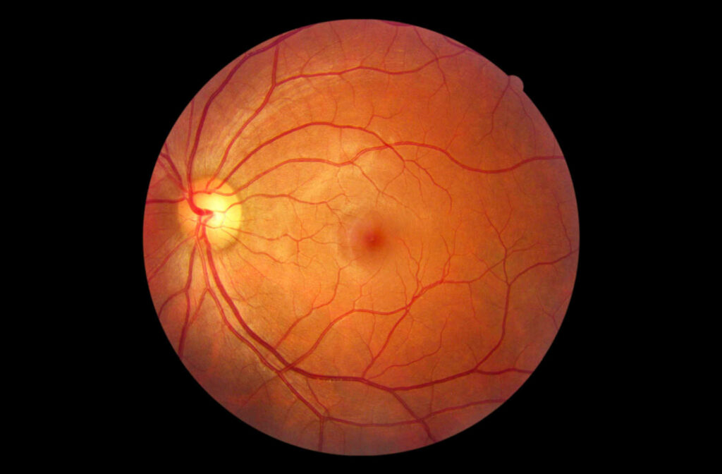A retinal image showing the optic nerve, macula, veins, and arteries